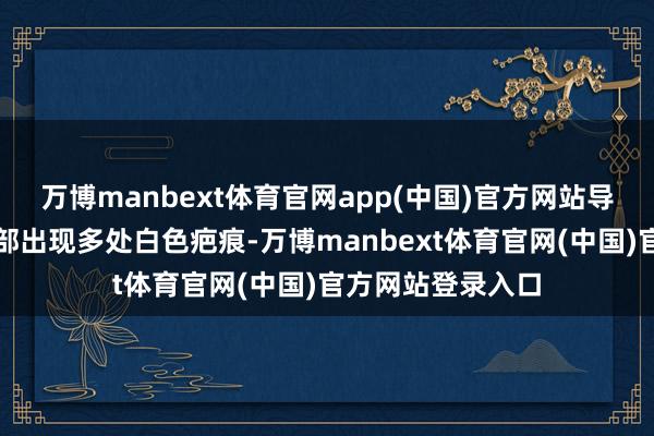 万博manbext体育官网app(中国)官方网站导致本东说念主眼部出现多处白色疤痕-万博manbext体育官网(中国)官方网站登录入口